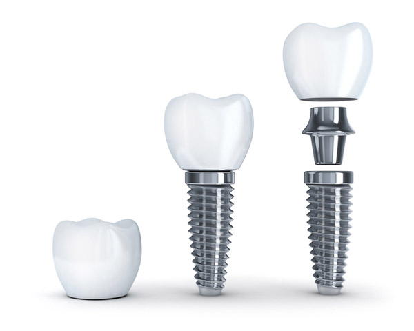 Diagram of dental implant with post Diagram of dental implant with post