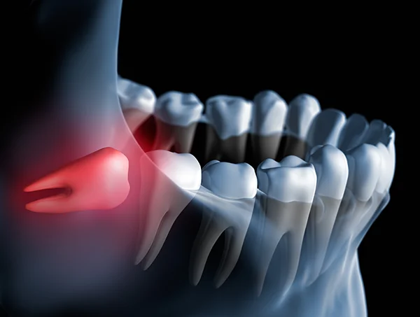 3D rendered xray of an impacted wisdom tooth (highlighted in red) butting against the tooth next to it 3D rendered xray of an impacted wisdom tooth (highlighted in red) butting against the tooth next to it
