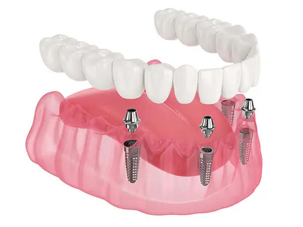 All-on-4 dental implant procedure, showing four titanium implants anchoring a full set of replacement teeth.