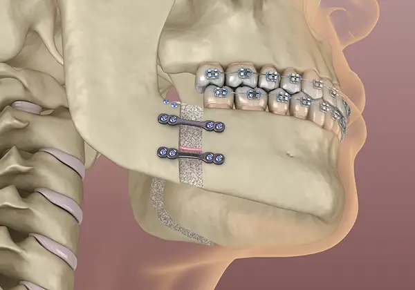 Orthognathic surgery illustration showing the process of jaw correction with plates and screws by  Coastal Maine Oral & Maxillofacial Surgery in Scarborough, ME